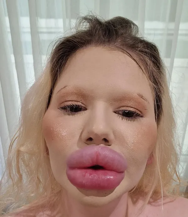 Жінка з найбільшими губами у світі зробила нові ін'єкції: який вона має вигляд (фото)