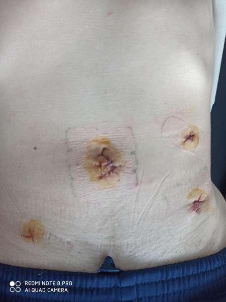 На Волині хірурги через чотири проколи прооперували виразку шлунку (фото 18+)