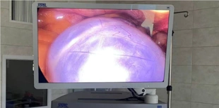 У Нововолинську лікарі видалили пухлину яєчника у 13-річної дівчинки (фото)