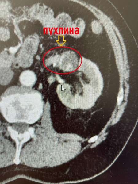 Вперше в Україні: у Ковелі провели надскладну операцію (фото)