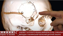Куля пройшла повз важливі ділянки: як у Луцьку оперували пораненого в голову юнака (відео)