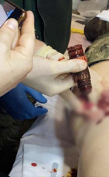 Хірурги вилучили бойову частину гранати з тіла військового (фото)