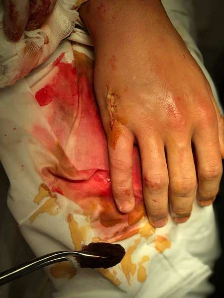 На Волині юнак зламав руку, вдаривши боксерську грушу (фото 18+)