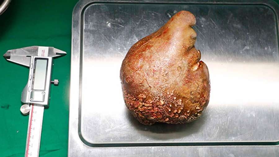 На Шрі-Ланці видалили найбільший у світі камінь у нирках вагою майже кілограм (фото)