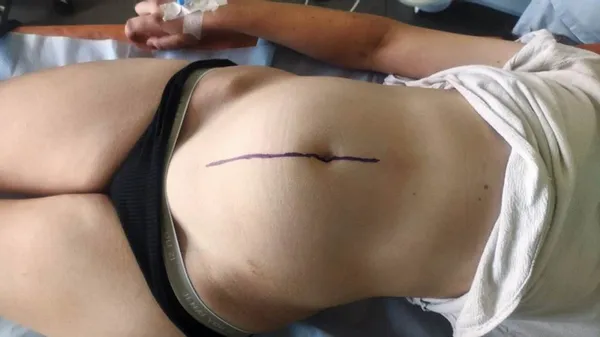 У дитячій лікарні в Луцьку 15-річній дівчині видалили трикілограмову пухлину (фото 18+)
