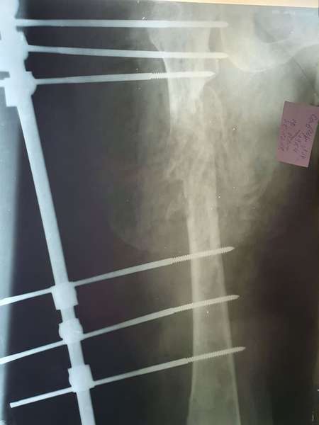 Унікальна операція у Любомлі: рятували онкохвору жінку з переломом стегна (фото 18+)