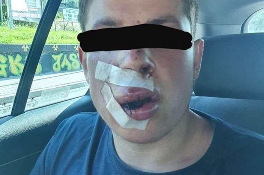 П’ятеро на одного: у Польщі побили студента, бо він з України (фото 18+)