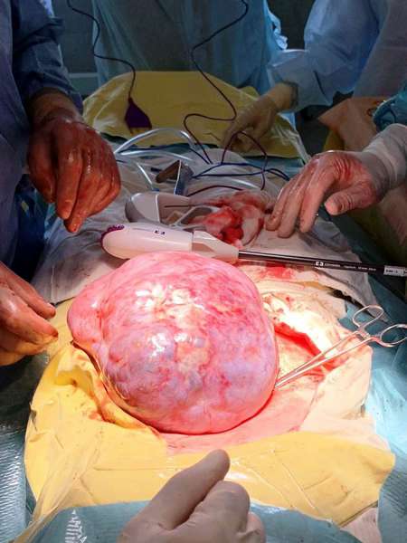 У дитячій лікарні в Луцьку 15-річній дівчині видалили трикілограмову пухлину (фото 18+)