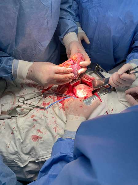 У луцькій лікарні вперше виконали трансплантацію нирки (фото, відео 18+)