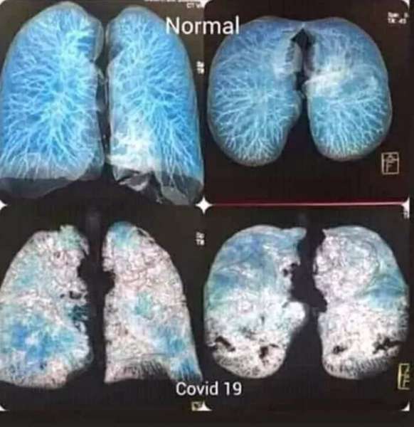 Показали фото легень хворого на COVID-19