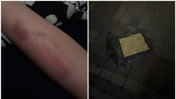 Травма хлопця та залатана яма