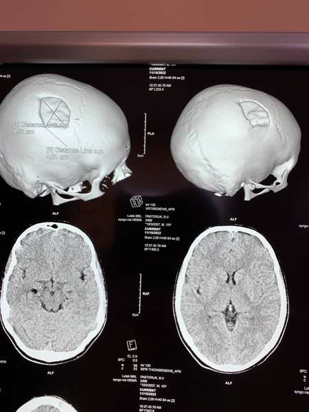У Рівному лікарі вставили в череп 15-річному волинянину титанову пластину (фото)