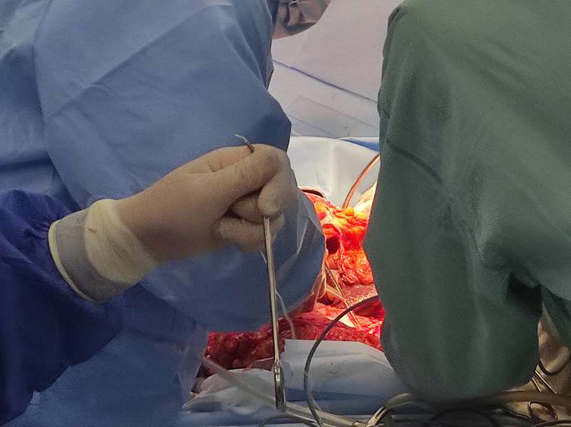 Серце, нирки, печінка: у Луцьку вперше вирізали з тіла 4 органи для пересадки (фото 18+, відео)