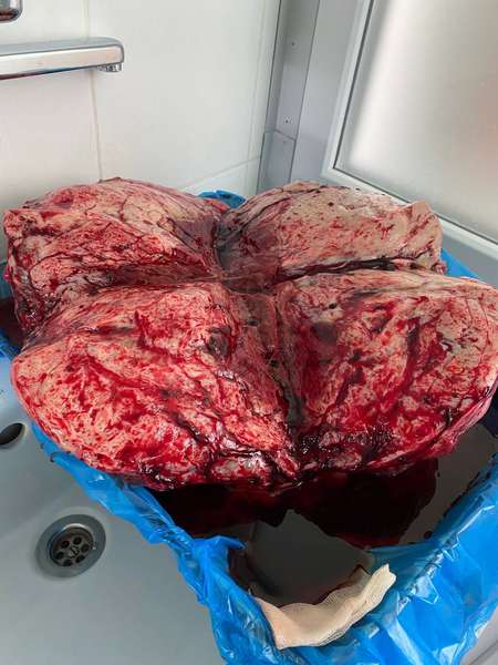 На Волині медики видалили жінці гігантську пухлину (фото 18+)