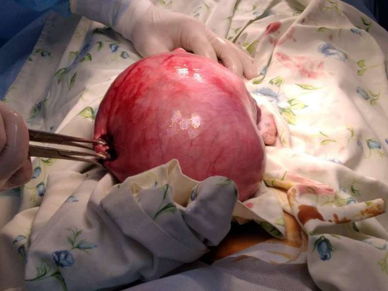 У Боголюбах жінці видалили пухлину, розміром з футбольний м'яч (Фото18+)