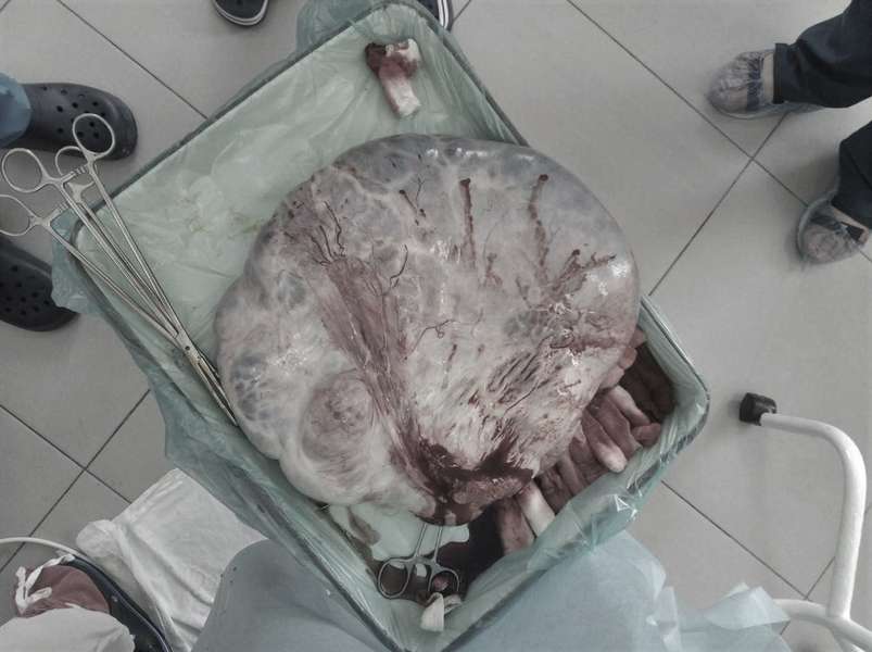 Наче вагітна: у Ковелі жінці видалили гігантську кістому (фото 18+)