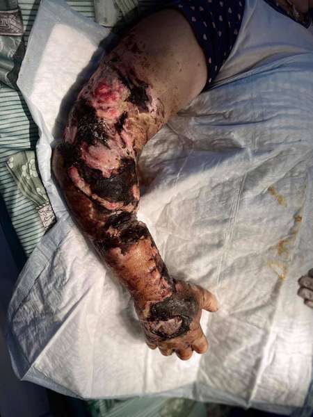 У Ковелі лікарі врятували жінці руку, яку скалічила зернова сівалка (фото 18+)