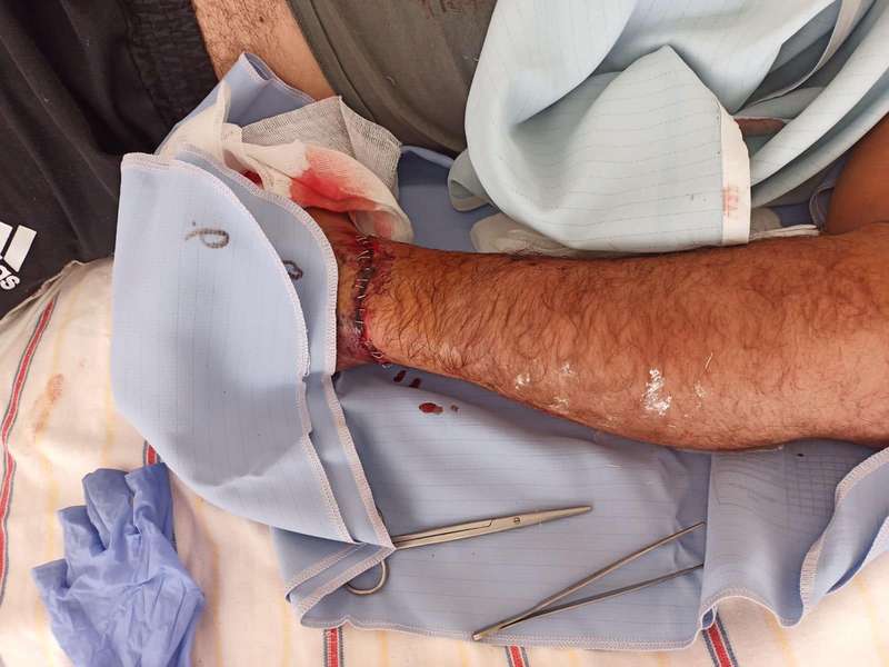 Трималася на шкірі: луцькі хірурги пришили чоловікові руку (фото 18+)
