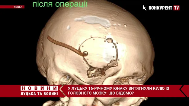 У Волинській обласній дитячій лікарні з мозку підлітка виймали кулю (фото, відео)