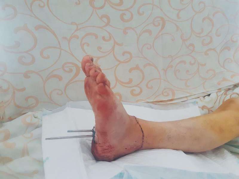 У луцькій лікарні вперше пришили жінці відрізану ногу (фото 18+)
