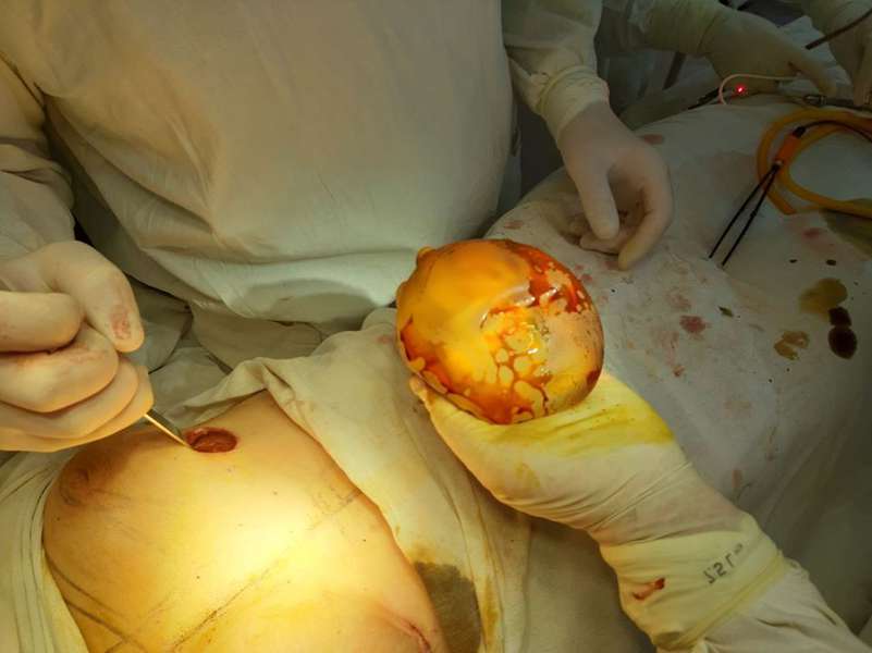Збільшення об’єму грудей і підтяжка: у ковельській лікарні – нові операції (фото 18+)