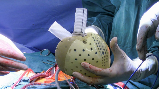 Німецькі лікарі вперше у світі трансплантували штучне серце