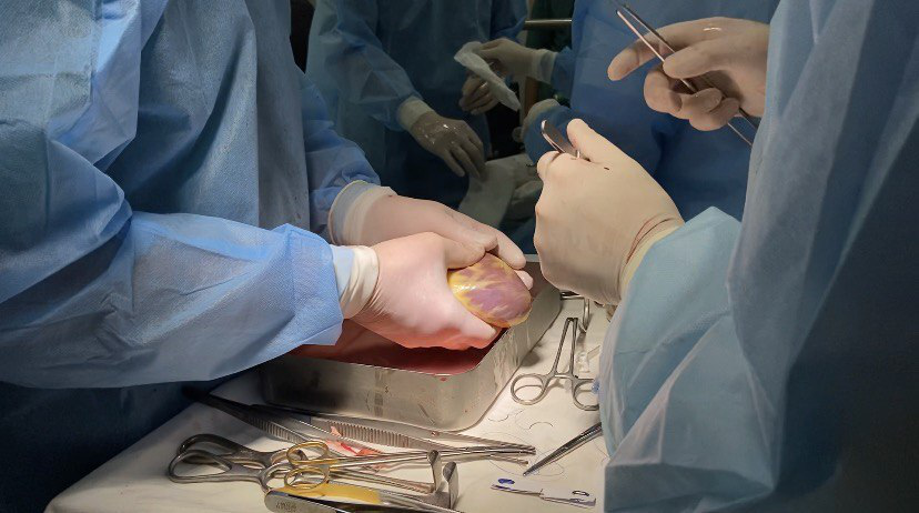 У Луцьку вперше зробили операцію з пересадки серця