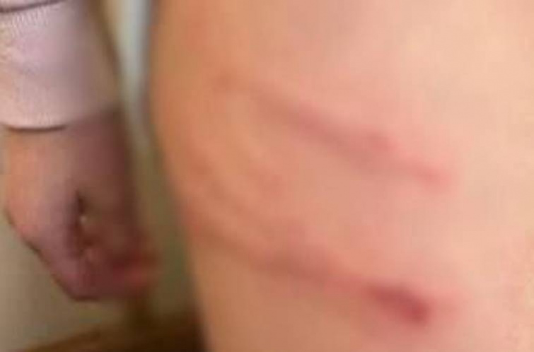 Січені рани на тілі: вихователька в дитячому садочку катувала дитину (фото)